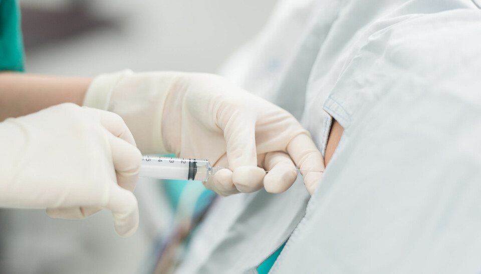 VANLIG MED EPIDURAL: Epidural er en vanlig smertelindring under fødselen.