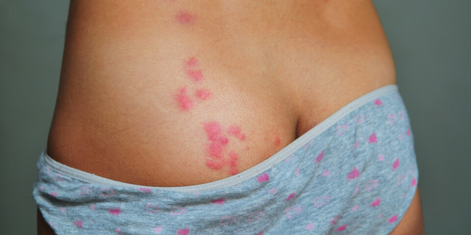 - Midd lever blant annet av døde hudceller