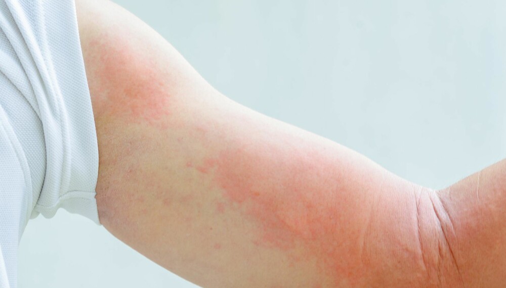 KLØENDE UTSLETT: Elveblest kan blant annet trigges av infeksjoner og allergi. 
Illustrasjonsfoto: Thinkstockphotos