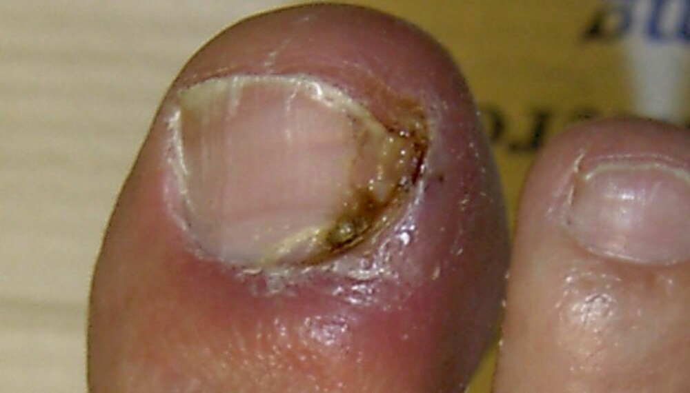 NEGLEROTBETENNELSE: En neglerotbetennelse skyldes en mindre skade på huden. Noe av neglebåndet blir borte og bakterier kommer inn.