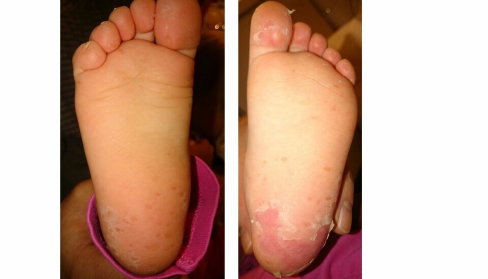 HUDEN FLASSER AV: Hånd-, fot- og munnsykdom gjør at huden flasser av. Dette skjer gjerne på slutten av sykdomsforløpet. Bildet til høyre er tatt noen dager etter bildet til venstre. Det kan ta lang tid før huden normaliseres.