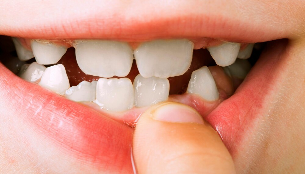 FALLER UT: Det å miste tenner er stas, og den påfølgende nattens tannfebesøk er minst like gjevt. 
Illustrasjonsfoto: Colourbox