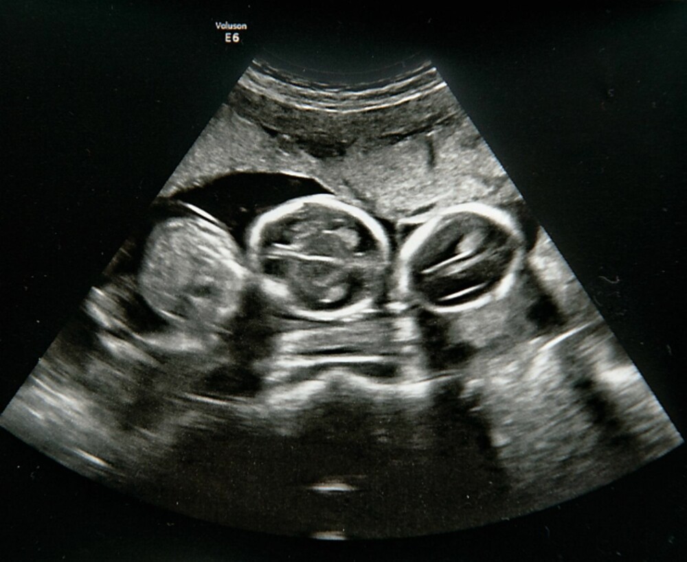 UNGEFLOKK I MAGEN: Ultralydbildet viser tre babyer! Alle sammen er jenter.