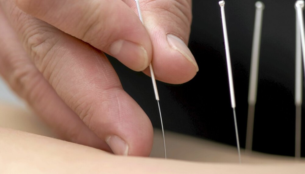NÅLER: Akupunktur har bare minimal effekt som smertelindring under fødsel.