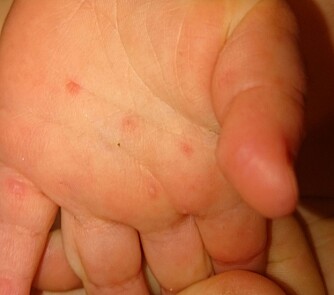 SMÅ BLEMMER: Hånd-, fot- og munnsykdom har fått navnet sitt etter blemmene som kjennetegner sykdommen.