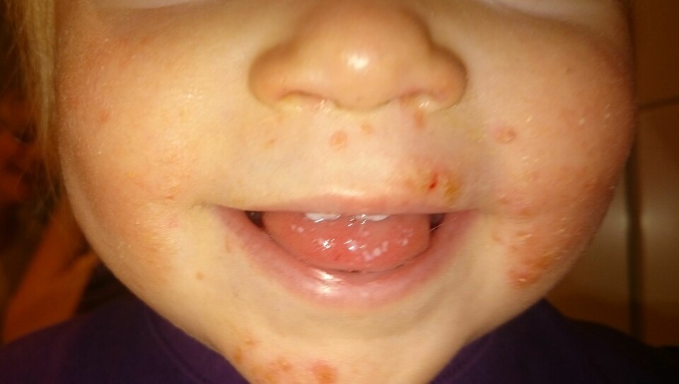 HÅND-, FOT- OG MUNNSYKDOM: Rundt munnen får den rammede rødt utslett og ømme, væskefylte blemmer. Blemmene har lett for å sprekke og gir da små sår i huden. I munnen og på tunga dukker det opp små blemmer og sår som gjør det vanskelig å spise.