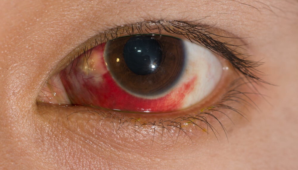 SPRENGT BLODKAR: Røde øyne kan se litt skremmende ut, men det er som oftest helt ufarlig. 