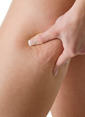FETT: Cellulitter dannes av fett i det innerste hudlaget.