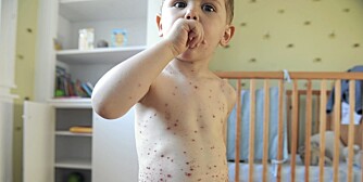 BILDE AV VANNKOPPER: Slik kan vannkopper se ut på barn. Forløpet merkes først som røde prikker, utvikler seg til større blemmer, og når blemmene sprekker, dannes skorper.
