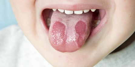Knop på tungen