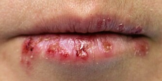 woman's face with a drying herpes on lips
