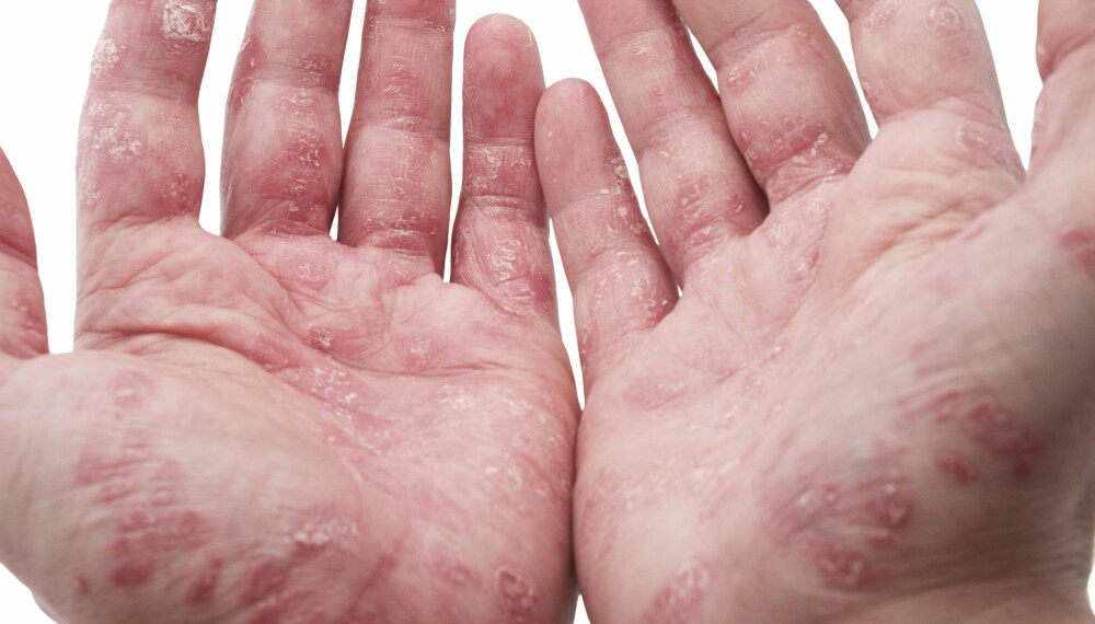 UTSLETT: Psoriasis er en kronisk hudsykdom med betennelse i huden og røde, skjellende utslett. FOTO: Thinkstockphotos