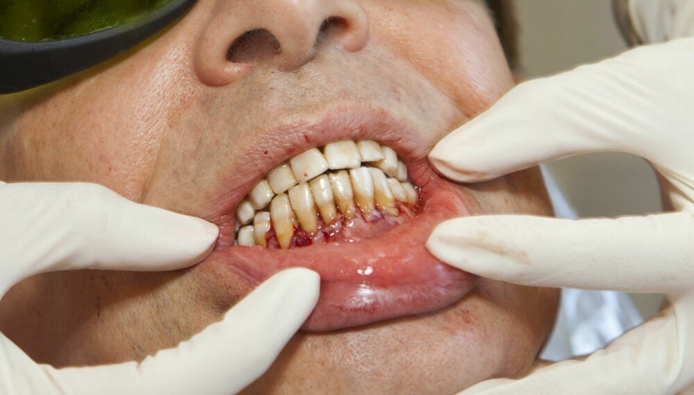 TANNKJØTTPROBLEMER: Alkohol og kaffe kan tørke ut munnen og før til infeksjoner i tannkjøttet.