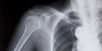 FROZEN SHOULDER: Å ta et røntgenbilde kan hjelpe til med å stille diagnosen forbedre frozen shoulder.
