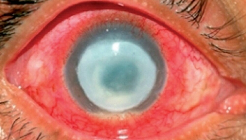 BAKTERIER: Den forferdelige tilstanden kalles Acanthamoeba keratitis, og skyldes amøber som tar seg inn i øyet på jakt etter bakterier de kan spise.