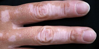 VITILIGO: Hudsykdommen Vitiligo kjennetegnes ved pigmentfrie, hvite flekker i huden.