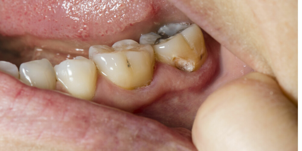 SKADER TENNENE: En av skadevirkningene av for mye sukker er tannråte.