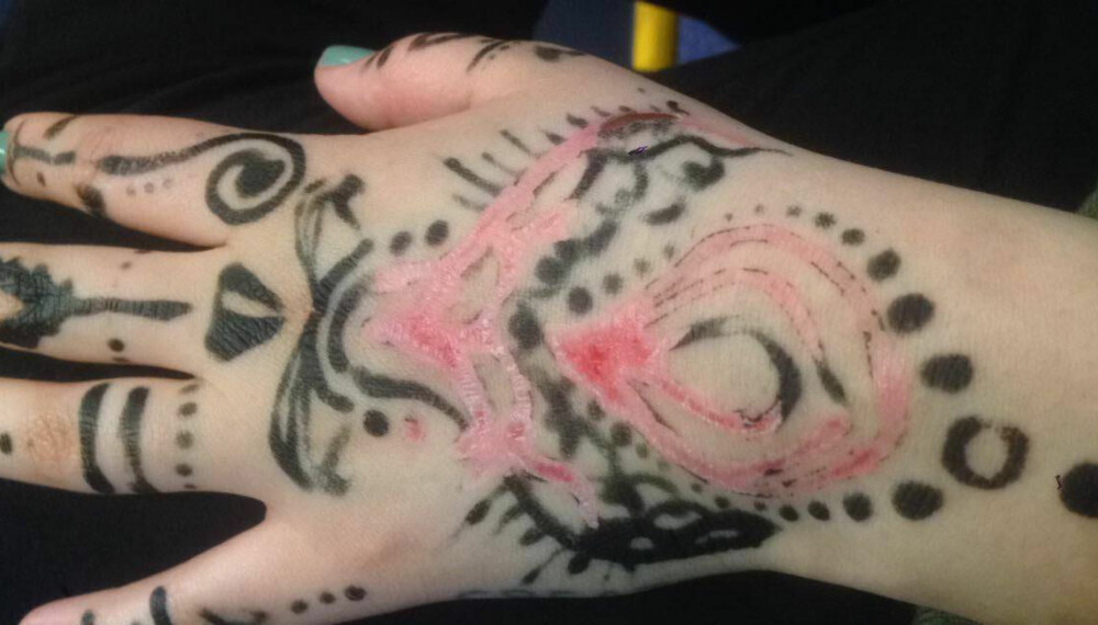 SORT HENNAMALING: Slik så hendene til Mirelle Gunn-Fevang (24) etter at hun prøvde sort hennatatovering. FOTO: Privat