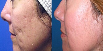 FØR OG ETTER: Fraxel er en ny laser som brukes mot blant annet aknearr. Disse bildene skal illustrere forbedringen etter bare tre behandlinger. FØR OG ETTER: Fraxel er en ny laser som brukes mot blant annet aknearr. Disse bildene skal illustrere forbedringen etter bare tre behandlinger.
