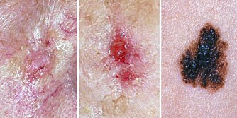 VANLIGST: De tre vanligste typene hudkreft er (f.v.) basalcellekarsinom, plateepitelkarsinom og føflekkreft eller malignt melanom.