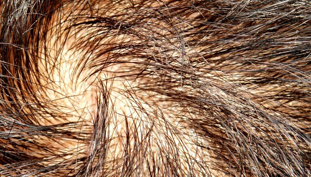 HÅRTAP: Omfanget av hårtap hos menn skyldes til dels arv. Hårtapet øker med mannens alder, og ofte mister man hår i vikene og på toppen.
