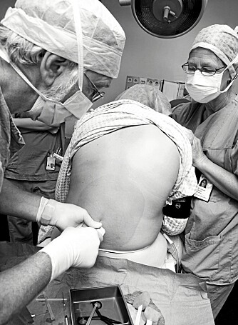BEDØVES: Spinalbedøvelsen settes av anestesilege. Gjennom nålen tres det inn en tynn slange (kateter) som blir liggende igjen i spinalrommet.