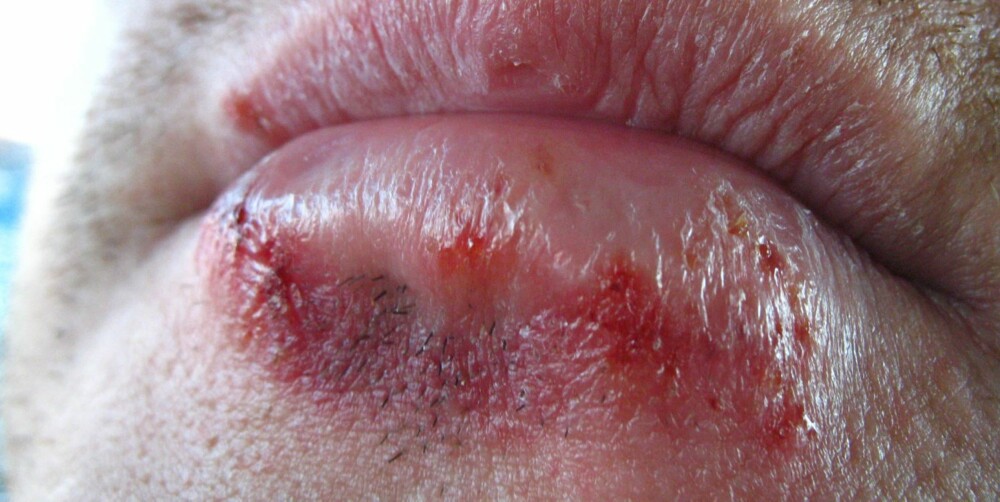ORALSEX-SMITTE: Man kan få infeksjon i munnen (herpes, klamydia, syfilis, gonoré) eller i hele kroppen om man utfører oralsex på en som er smittet. Bildet viser herpes, human papilloma-virus.