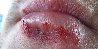 ORALSEX-SMITTE: Man kan få infeksjon i munnen (sopp, herpes, klamydia, syfilis, gonoré) eller i hele kroppen om man utfører oralsex på en som er smittet. Bildet viser herpes, human papilloma-virus.