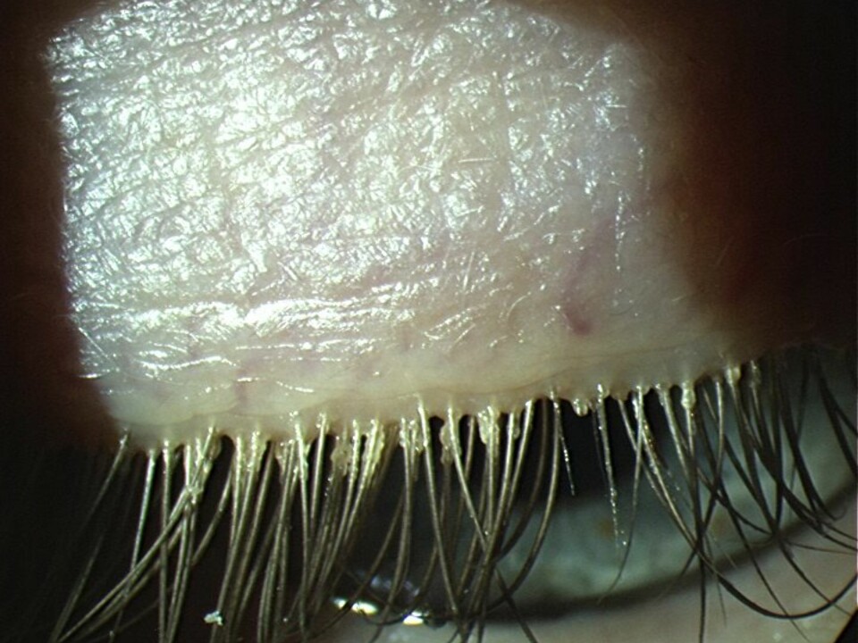 De aller fleste voksne har midd på øyelokket