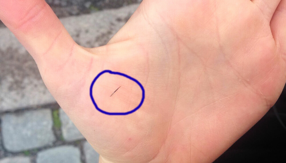 FLIS I FINGEREN: Kan føre til infeksjon om du ikke fjerner den. Etter at du har renset såret, sett på et plaster. FOTO: Jenny Mina Rødahl FLIS I FINGEREN: Kan føre til infeksjon om du ikke fjerner den. Etter at du har renset såret, sett på et plaster. FOTO: Jenny Mina Rødahl