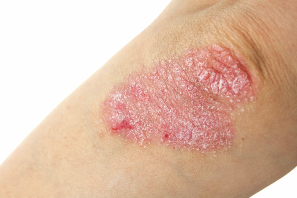 UTSLETT: Psoriasis er en kronisk hudsykdom med betennelse i huden og røde, skjellende utslett. FOTO: Thinkstock