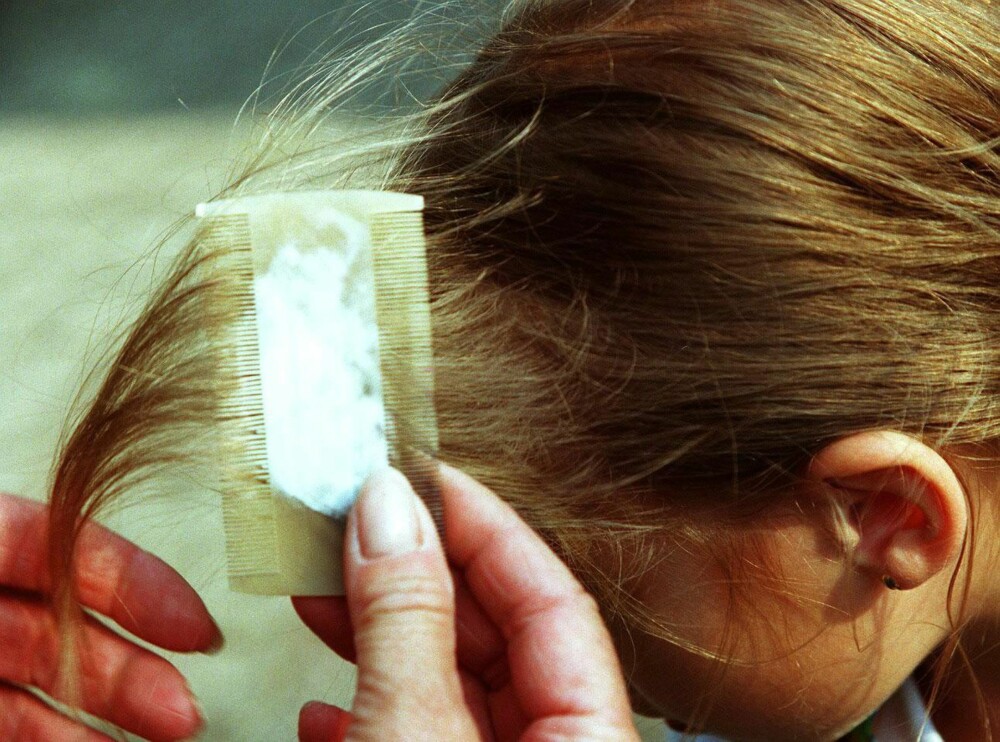 BEHANDLING MOT LUS: Hodelus kan behandles med lusemiddel, barbering eller kjemming av hår. BEHANDLING MOT LUS: Hodelus kan behandles med lusemiddel, barbering eller kjemming av hår.