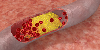 TETTES: Kolesterolet flyter rundt i blodet i form av små kuler. Blir det for mye av det i blodet kan det med årenes løp gi avleiringer som tilslutt tetter igjen blodåren.