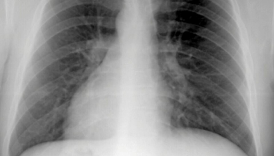 DØDELIG: KOLS er nå den fjerde vanligste dødsårsaken i vestlige land. Mange vet ikke at de har det.