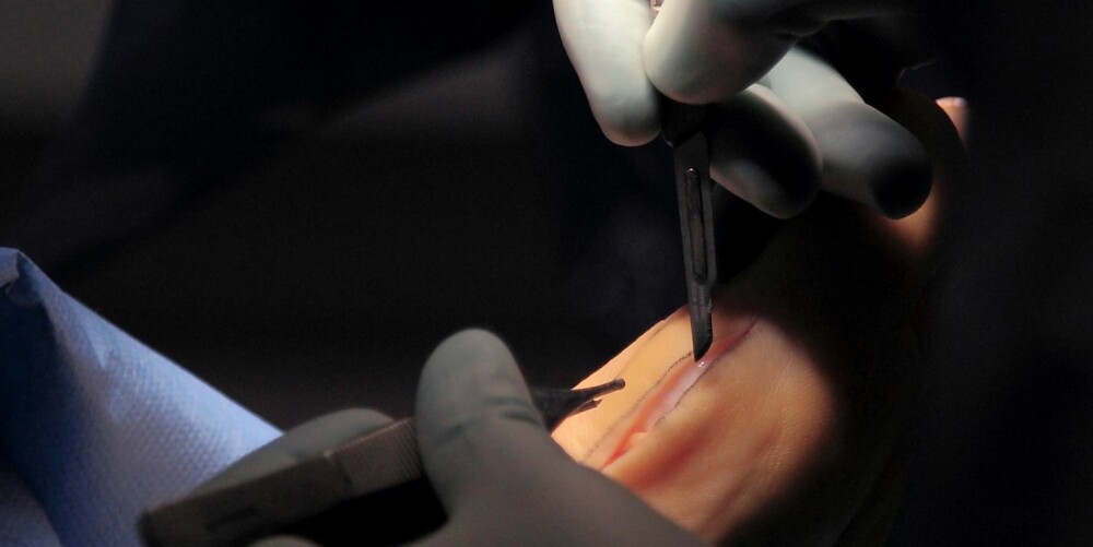 2. Kirurgen skjærer et snitt i huden langs den opptegnede linjen over det skjevstilte stortåleddet. Den stiplede linjen over markerer en nerve som helst ikke skal berøres.