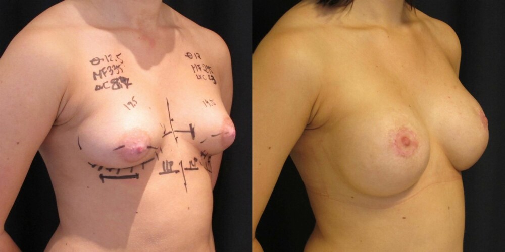 Brystforstørrelse av liten nedre brystpol med forminskning av areola. Før og etter.