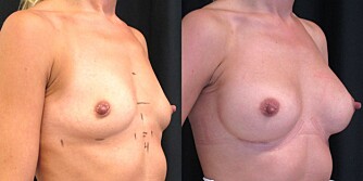 Brystforstørrelse etter tap av brystvev pga amming. Før og etter.