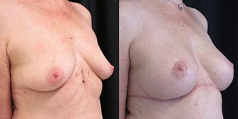 Brystforstørrelse med lite løft rundt areola hos eldre kvinne. Før og etter.
