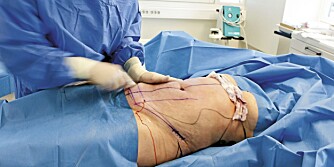 MAGEPLASTIKK: Stadig flere norske kvinner gjør som denne 39 år gamle kvinnen; de opererer bort skjemmende mager og løshud ved hjelp av plastisk kirurgi. Mens operasjonen tar fire timer, kan det ta opptil ett år før man ser det endelige resultatet.