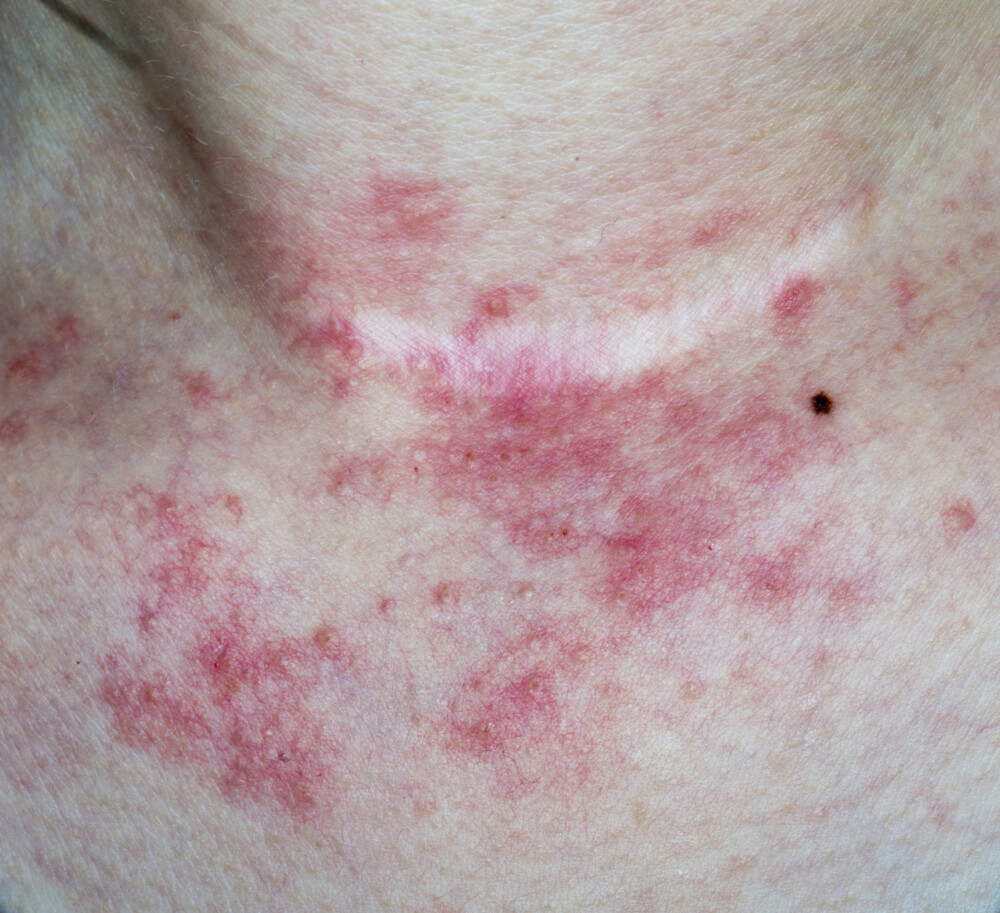 IKKE ROSECEA: Selv om de kan ligne, er seboreisk dermatitt noe ganske annet enn rosecea. IKKE ROSECEA: Selv om de kan ligne, er seboreisk dermatitt noe ganske annet enn rosecea.