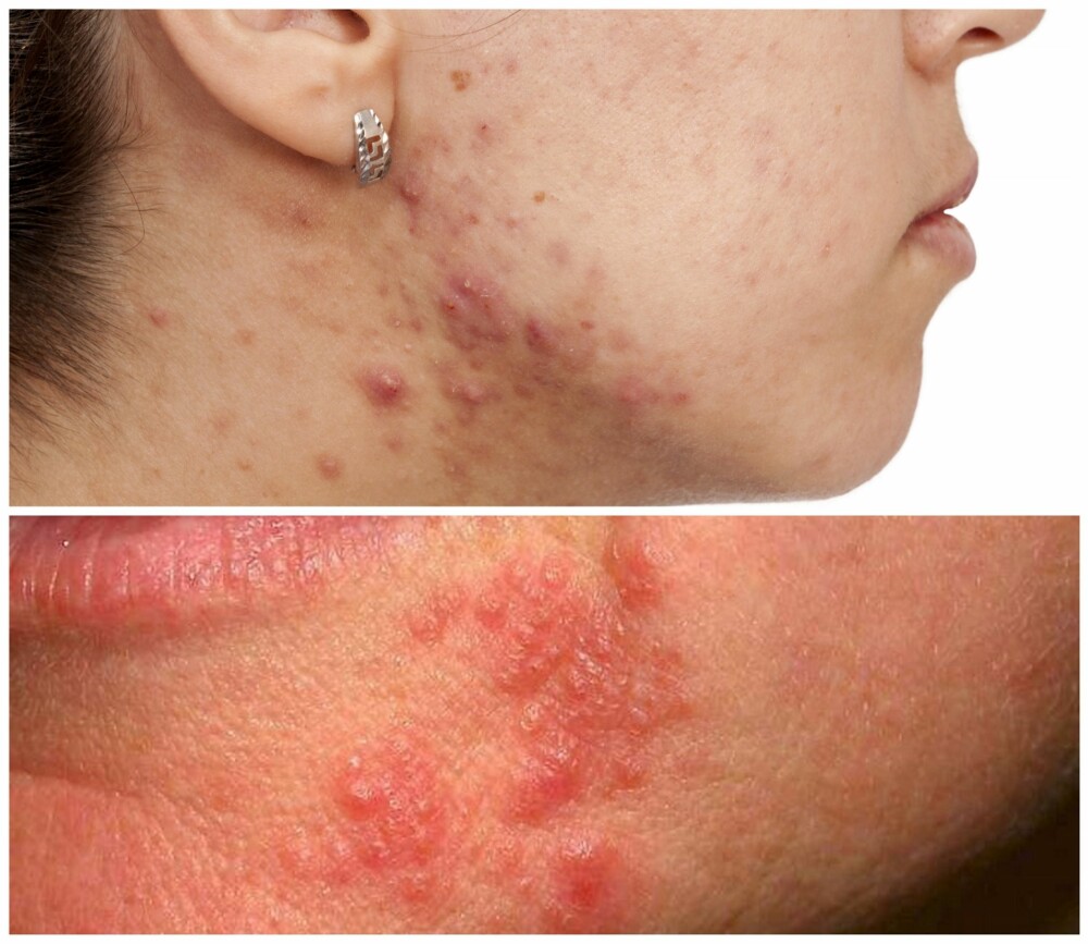 SER DU FORSKJELLEN?: Det er ikke rart man kan forvekse akne (øverst) til med perioral dermatit (nederst).