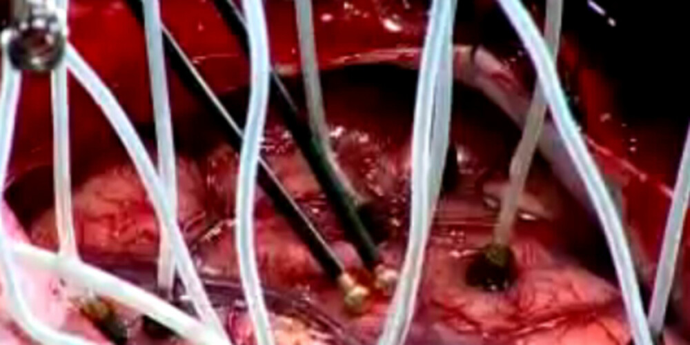 KIRURGISK NÆRBILDE: Youtube-videoene viser imponerende detaljrike bilder fra de kirurgiske inngrepene.