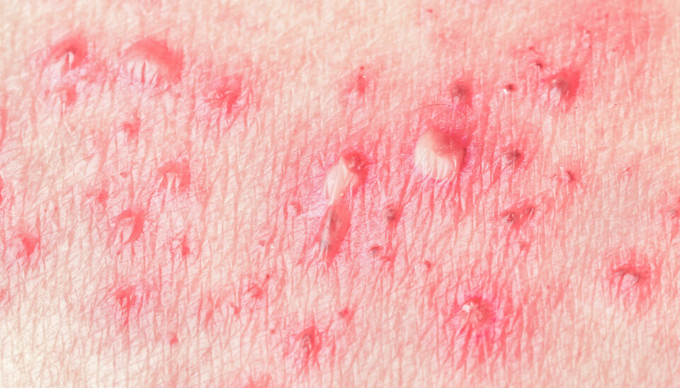 HELVETESILD: Smertene ved helvetesild kan oppleves som svært intense.
Illustrasjonsfoto: Colourbox