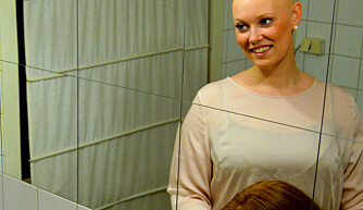 UTEN PARYKK: Oda Nybakken Molstad (23) har sykdommen Alopecia Areata som har resultert i hårtap på hele kroppen.