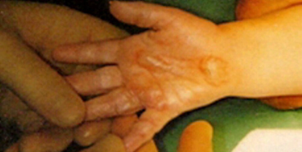 SMERTEFULLT: Forbrenninger er ekstremt smertefulle, og kan sette pasienten i sjokk. Andre- og tredjegradsforbrenninger kjennetegnes ved at det dannes blemmer i huden.