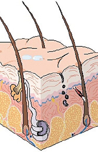 TRE LAG: Huden består av tre lag, kalt overhud (epidermis), lærhud (dermis corium) og underhud (hypodermis subcutis). Ved tredjegradsforbrenning er alle tre hudlag skadet.