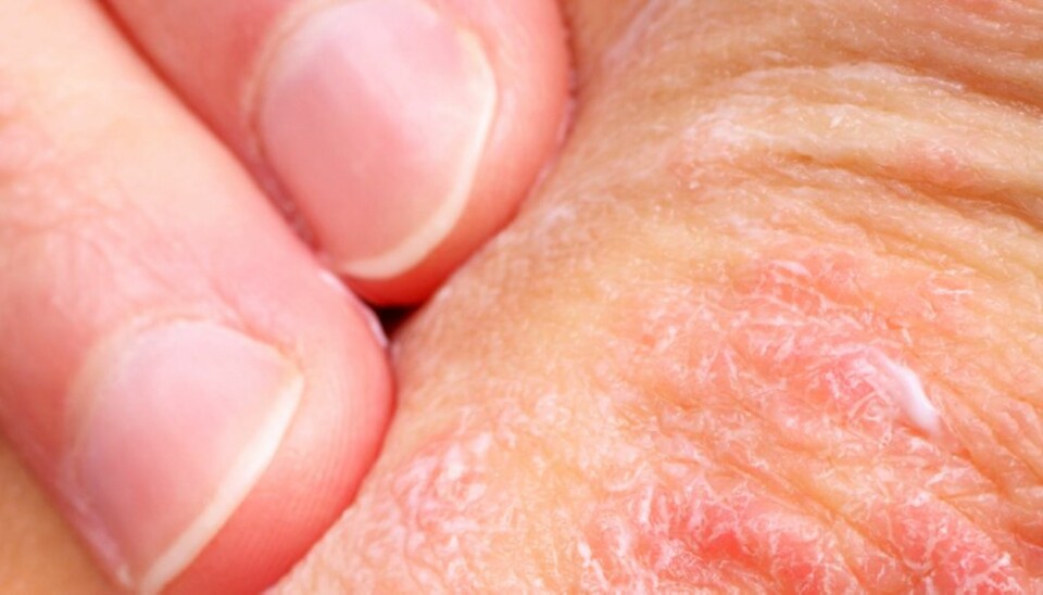 TØRRE, RØDE FLEKKER: Man kan ha psoriasisflekker over hele kroppen, men ansiktet rammes vanligvis ikke.