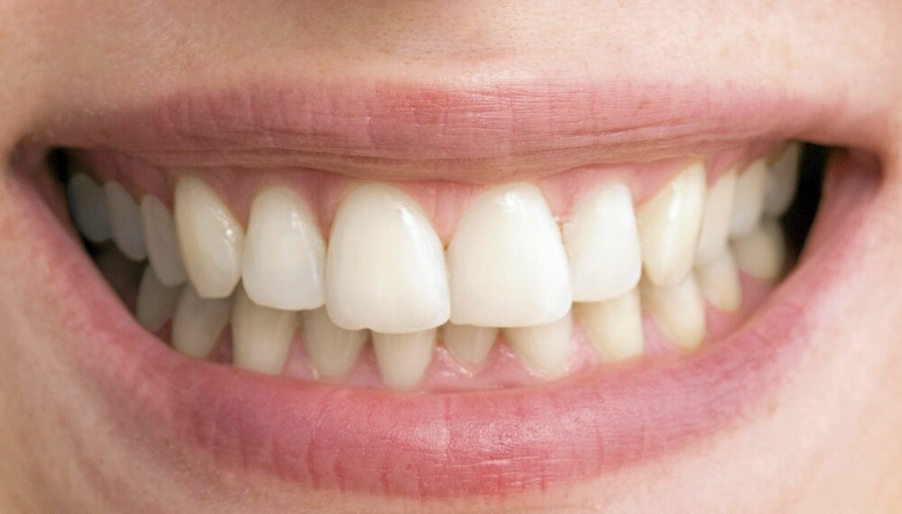 PERLERAD: Ønsket om en kritthvit perlerad fører til at mange forsøker hjemmebleking av tenner. Det kan være bedre enn å gjøre det på klinikk, mener tannlegen.