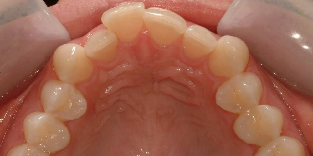 FØR: Slik så tennene ut før behandling med Inman Aligner.