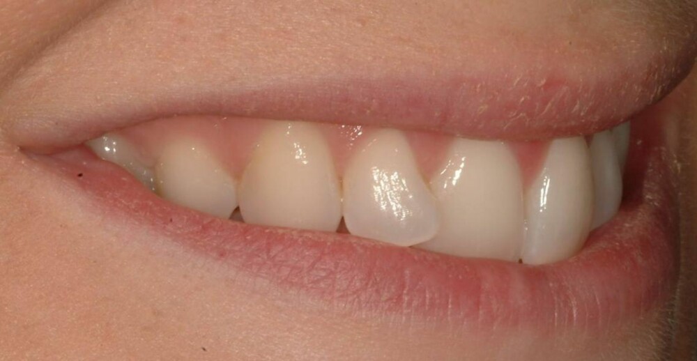 ETTER: Slik så tennene ut etter behandling med Inman Aligner.